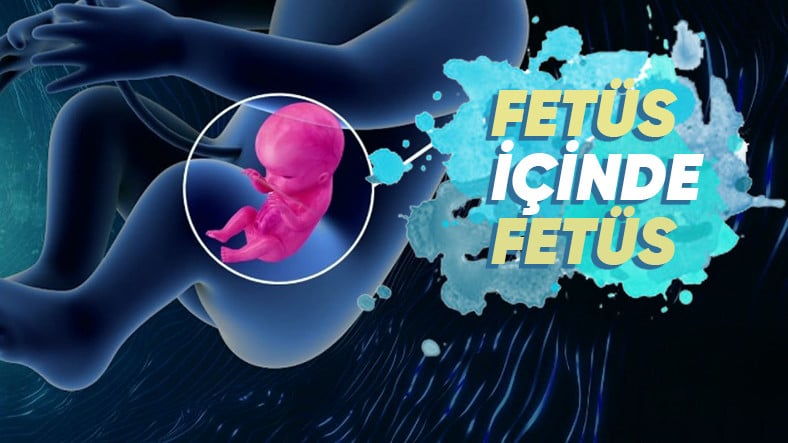 Kardeş Kalıntılarını Vücutta Taşımak: Fetüs İçinde Fetüs