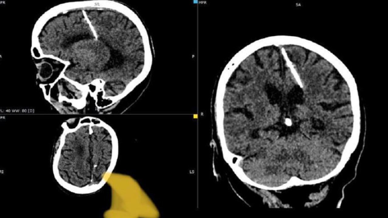 80 yılı beynindeki iğneyle sorunsuz bir şekilde yaşayan kadın, doktorları bile şaşırttı